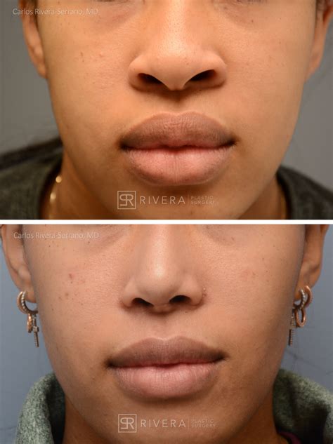 Buccal fat removal / Bichectomi .